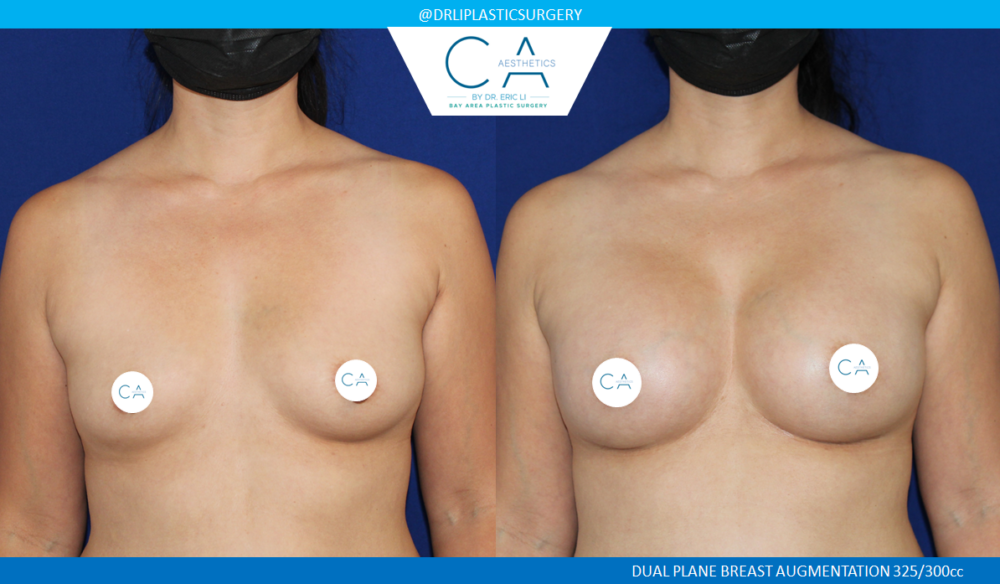 Asian Breast Augmentation case #2517