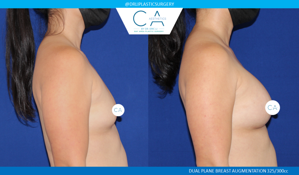 Asian Breast Augmentation case #2517