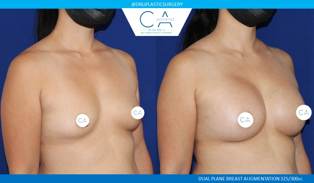 Asian Breast Augmentation case #2517