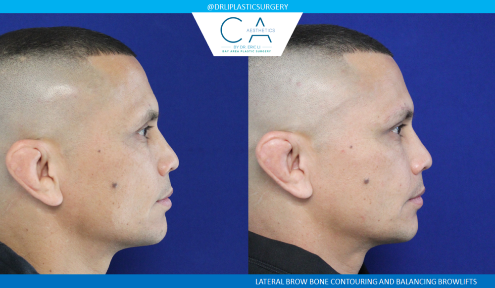 Upper Blepharoplasty case #3968