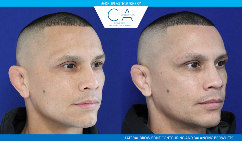 Upper Blepharoplasty case #3968