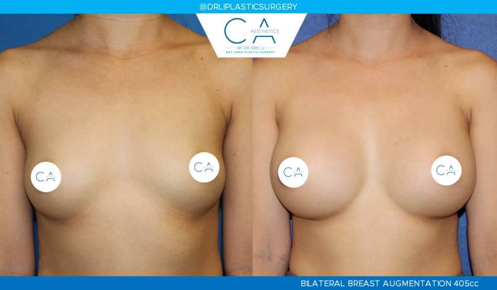 Asian Breast Augmentation case #2514