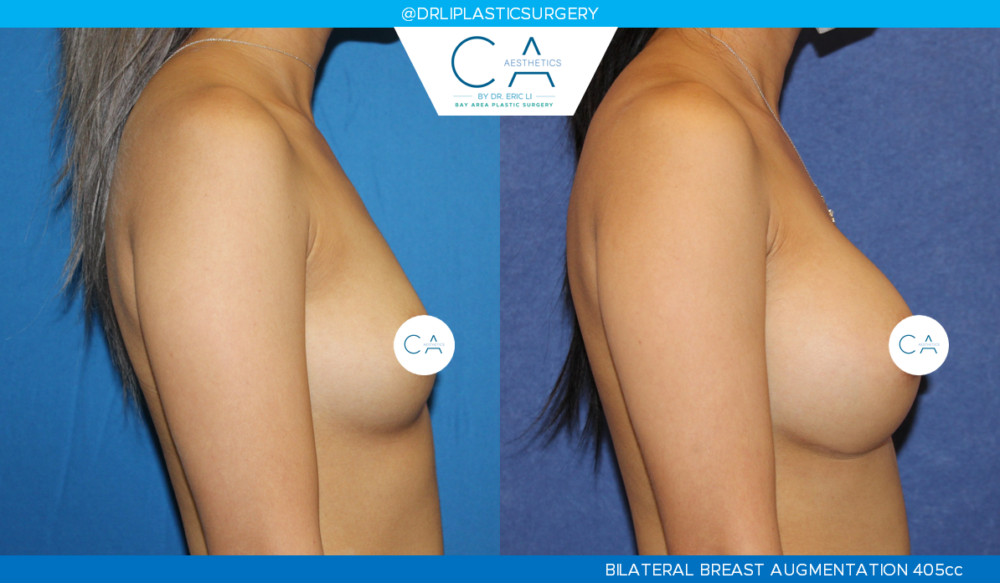 Asian Breast Augmentation case #2514