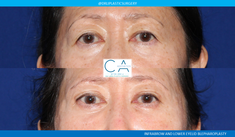 Upper Blepharoplasty case #3970