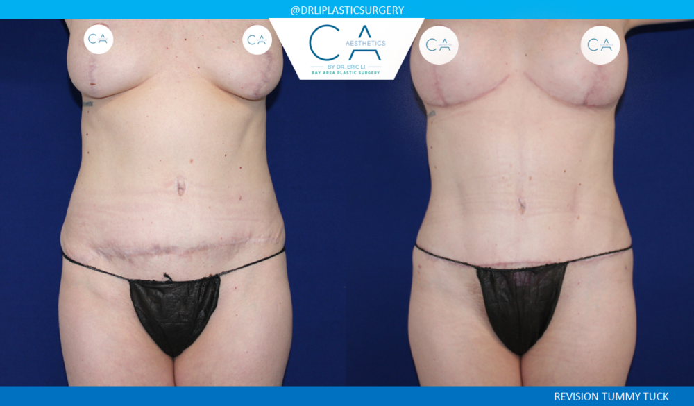 Tummy Tuck case #2570