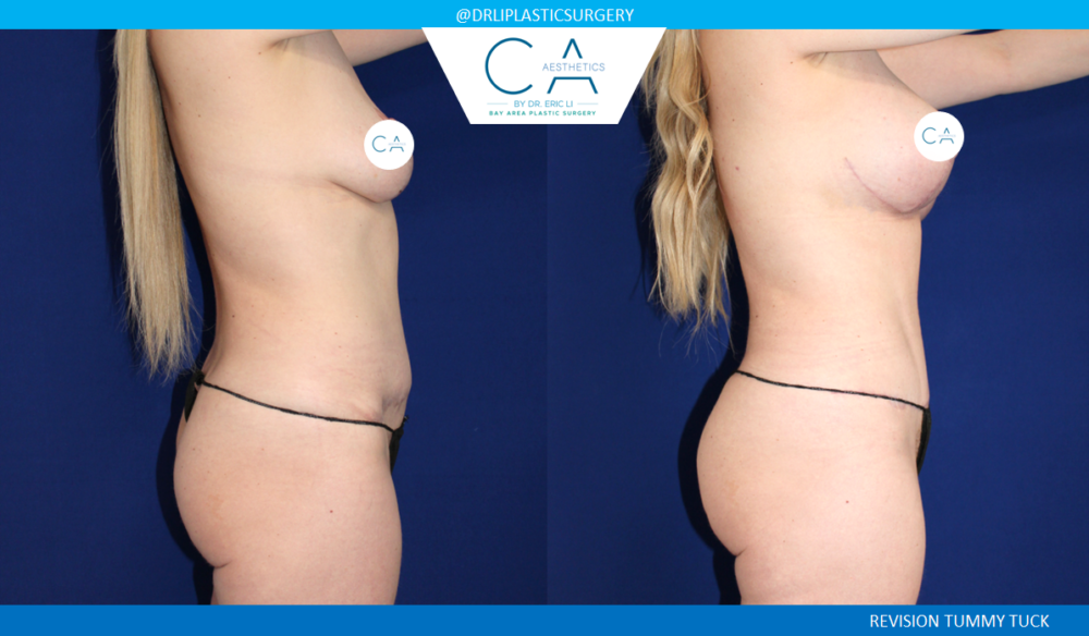 Tummy Tuck case #2570