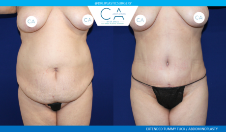 Tummy Tuck case #2588