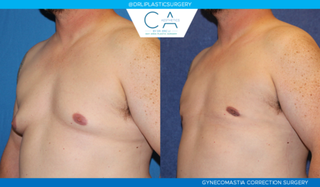 Gynecomastia case #2872