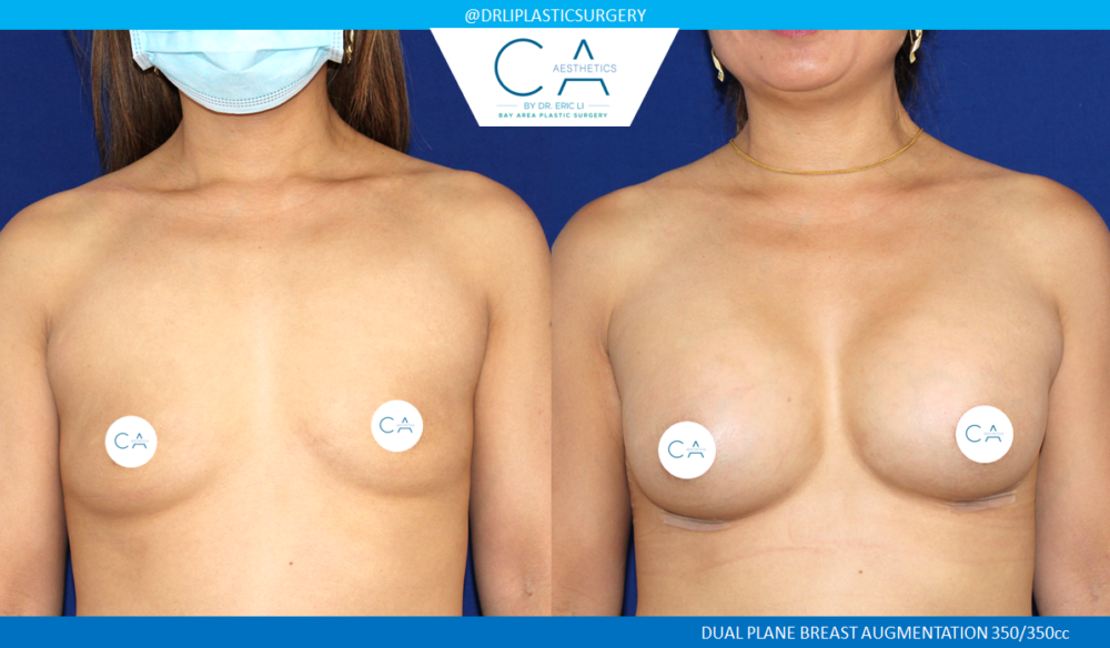 Asian Breast Augmentation case #2502