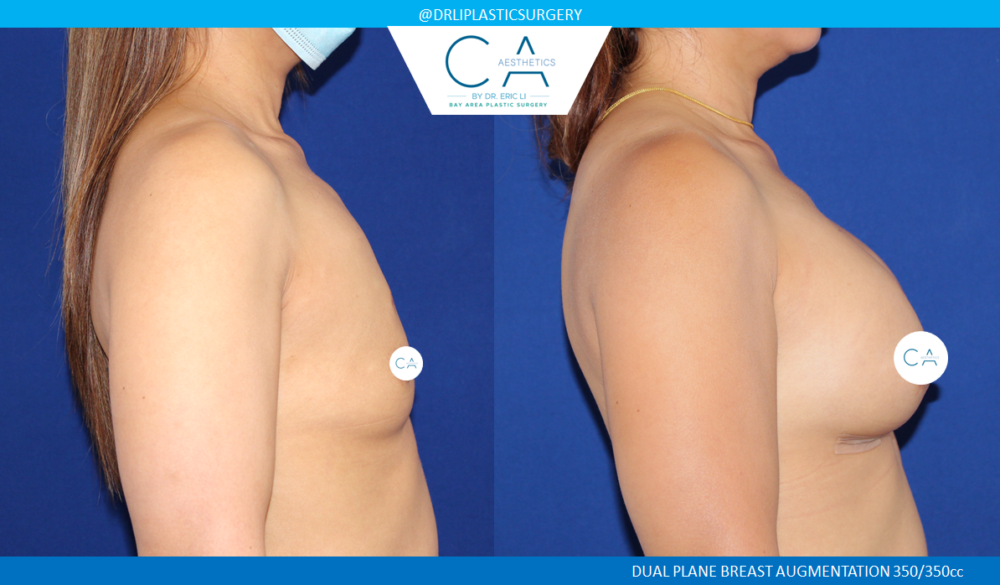 Asian Breast Augmentation case #2502