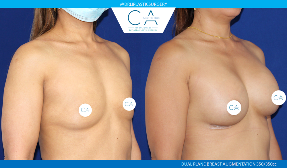 Asian Breast Augmentation case #2502