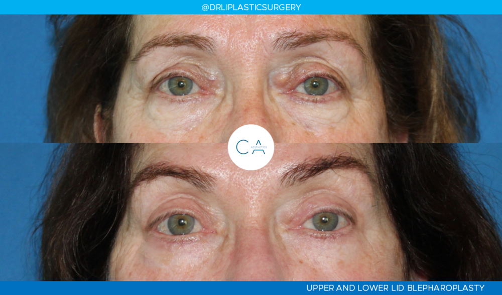 Upper Blepharoplasty case #3958