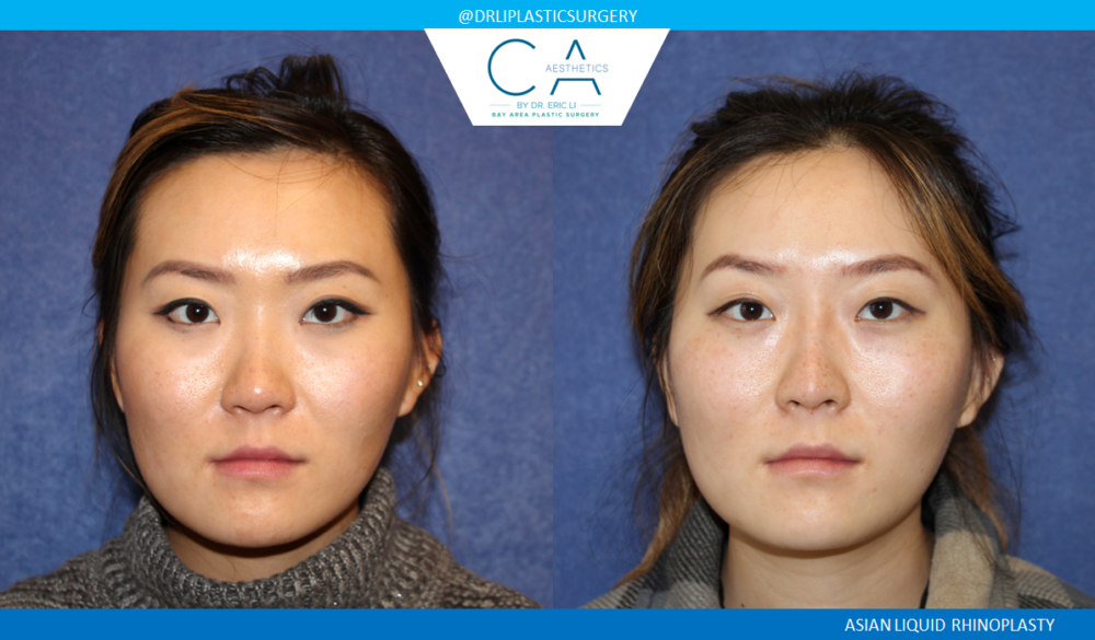 Asian Rhinoplasty case #2400