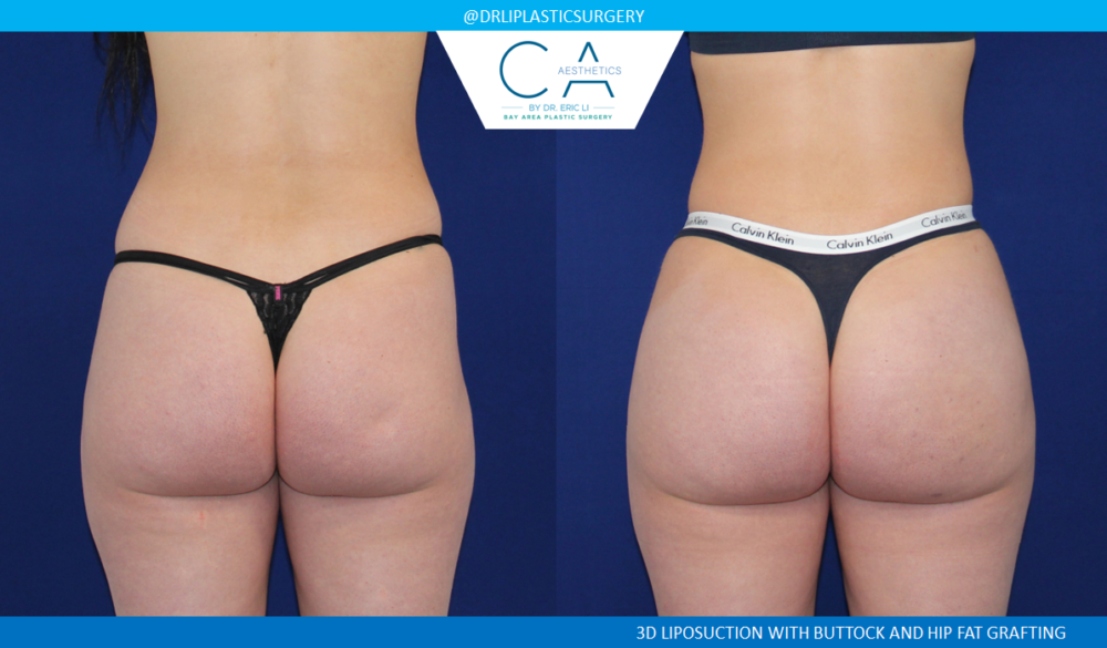 Brazilian Butt Lift case #3947