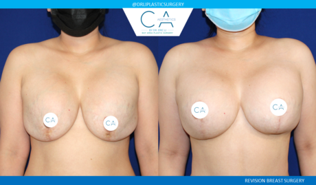 Breast Revision case #3788