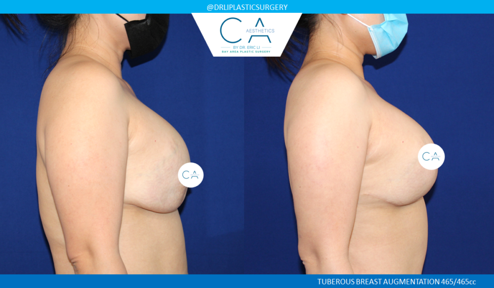 Breast Revision case #3788