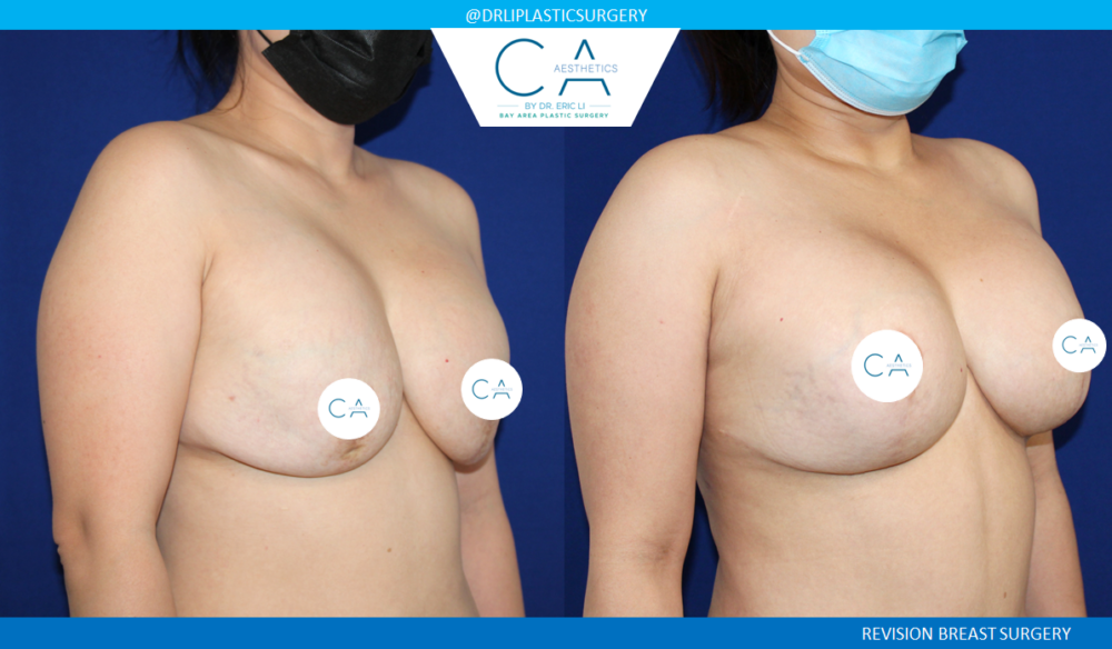 Breast Revision case #3788