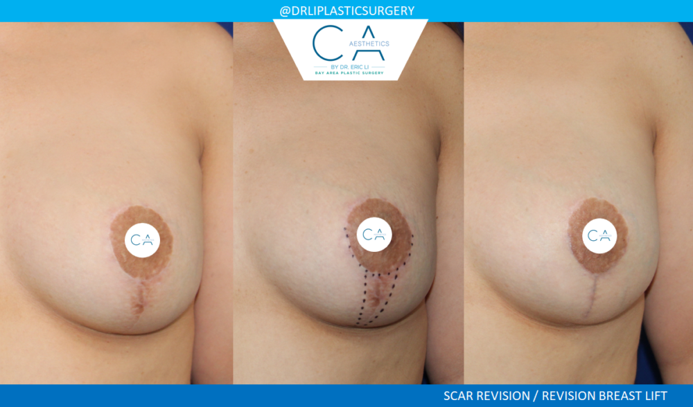 Breast Revision case #3773