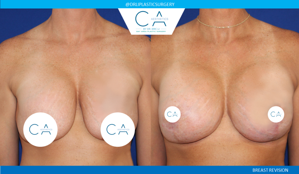 Breast Revision case #3756