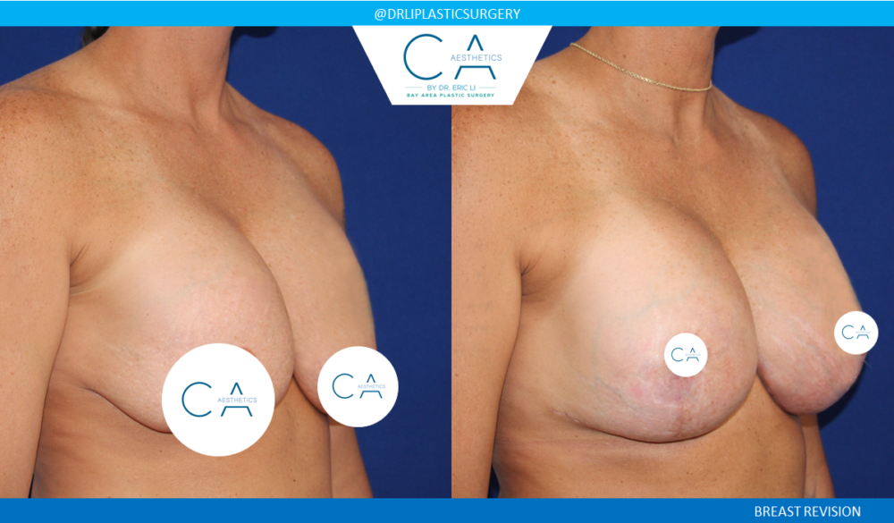 Breast Revision case #3756