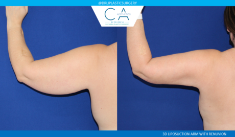 Arm Lift (Brachioplasty) case #2353