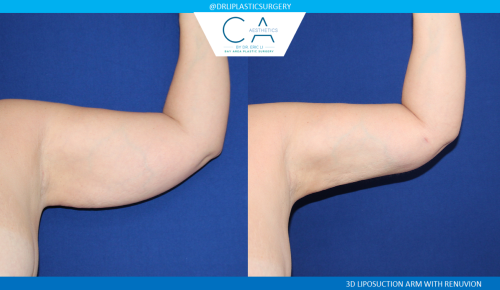 Arm Lift (Brachioplasty) case #2353