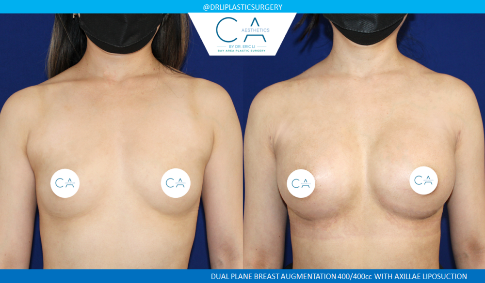 Asian Breast Augmentation case #2499