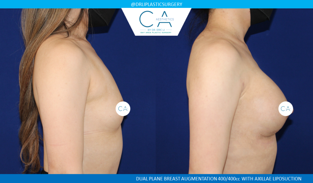 Asian Breast Augmentation case #2499