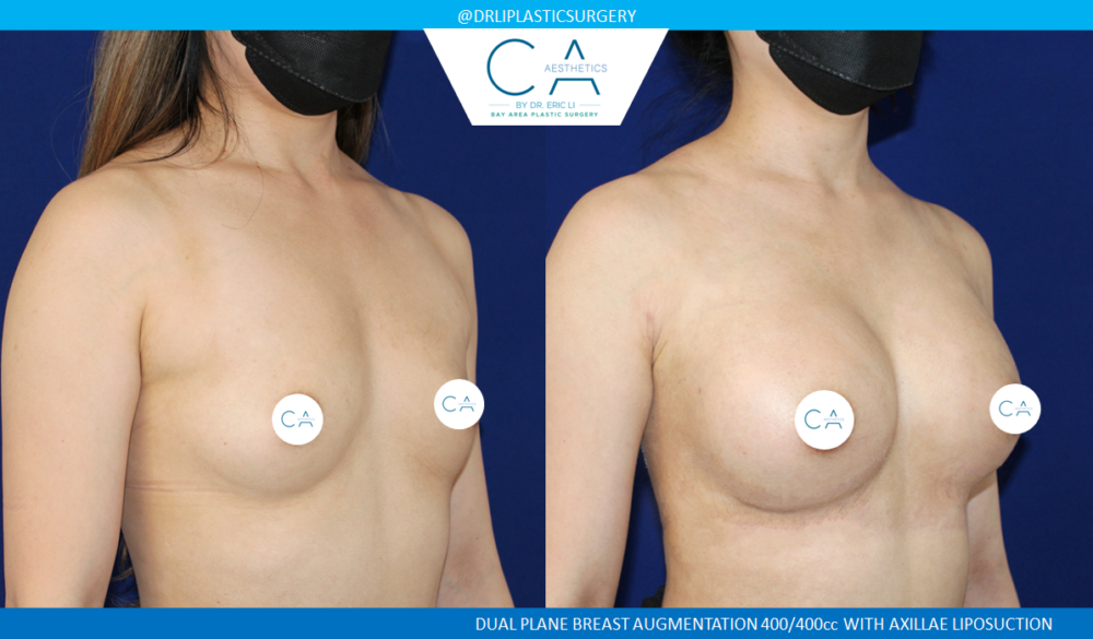 Asian Breast Augmentation case #2499