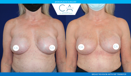 Fat Transfer Breast Augmentation case #2808