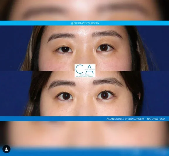 Instagram real patient Asian Eye lift