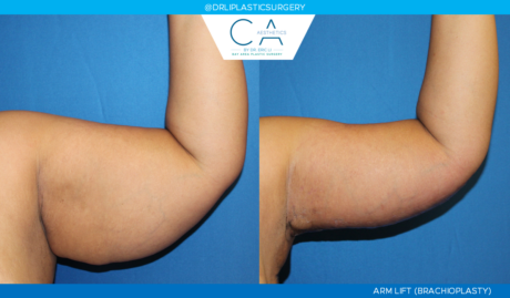 Arm Lift (Brachioplasty) case #2342