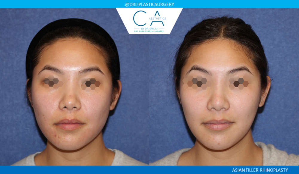 Asian Rhinoplasty case #2392