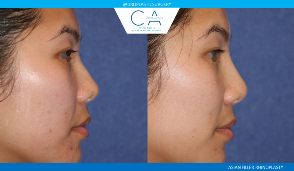 Asian Rhinoplasty case #2392