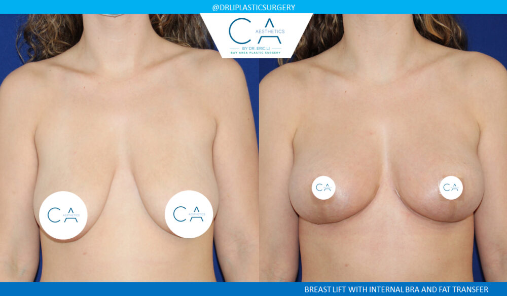 Fat Transfer Breast Augmentation case #2812