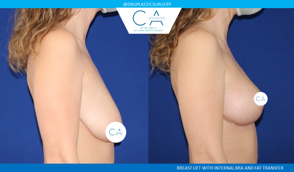 Fat Transfer Breast Augmentation case #2812