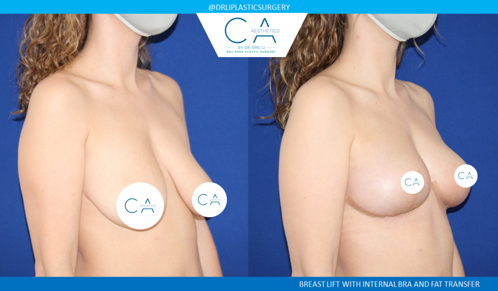 Fat Transfer Breast Augmentation case #2812