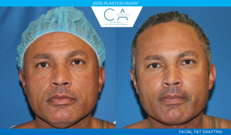 Facial Implants and Fat Transfer case #2802