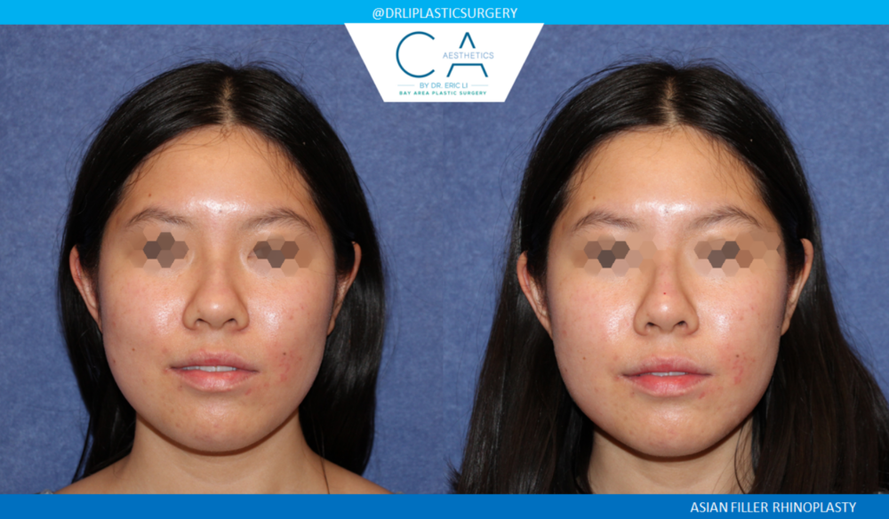 Asian Rhinoplasty case #2394