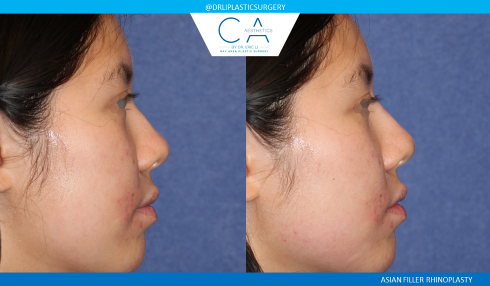 Asian Rhinoplasty case #2394