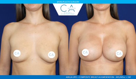 Fat Transfer Breast Augmentation case #2816