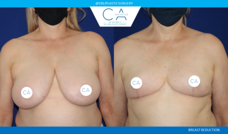 Breast Reduction case #3866