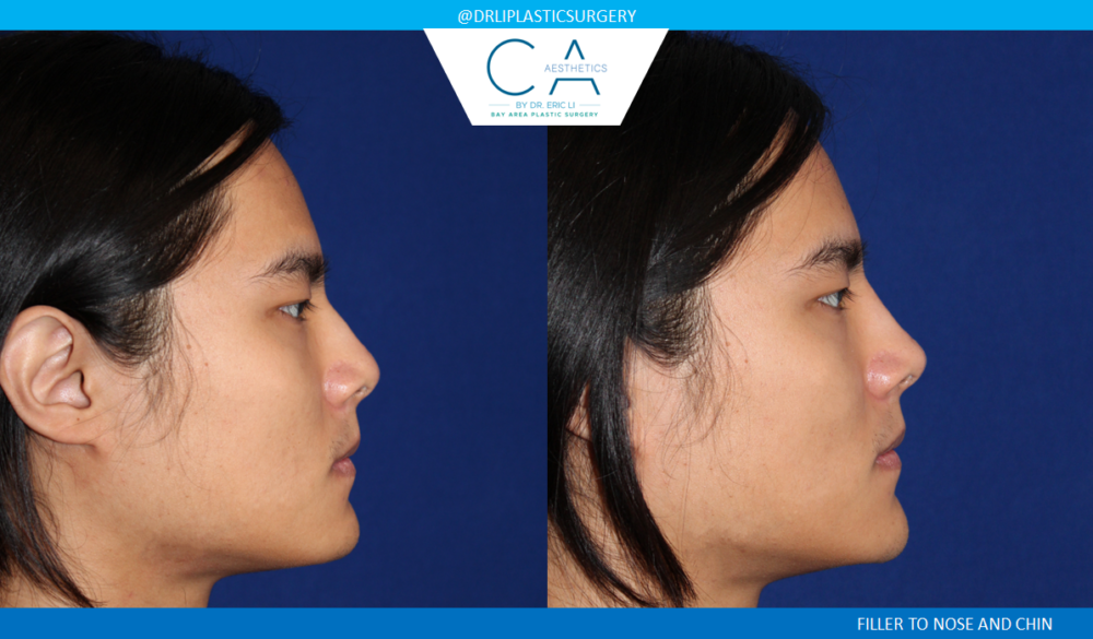 Asian Rhinoplasty case #2399