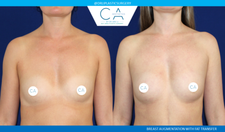 Fat Transfer Breast Augmentation case #2817