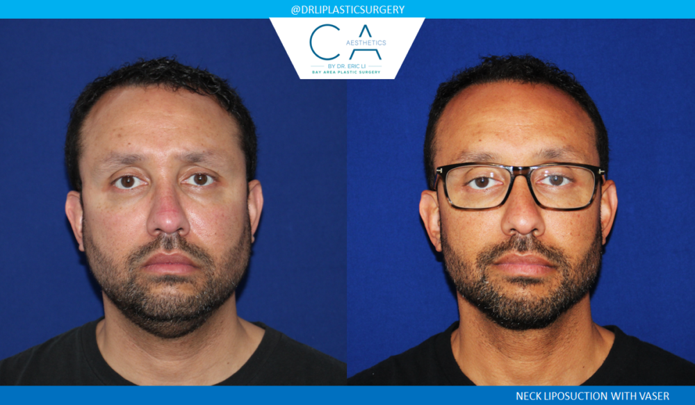 Face & Neck Liposuction case #2755