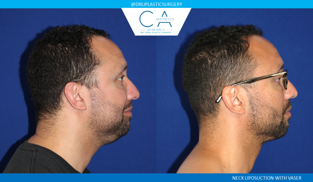 Face & Neck Liposuction case #2755