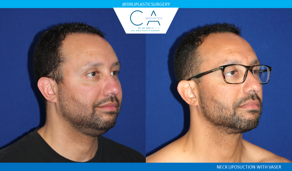 Face & Neck Liposuction case #2755