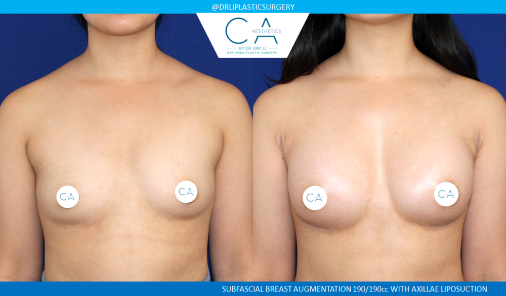 Asian Breast Augmentation case #2522