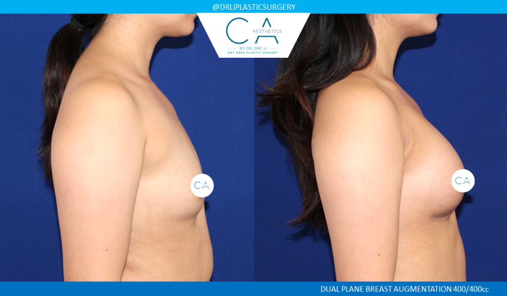 Asian Breast Augmentation case #2522