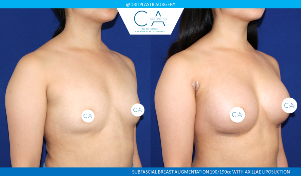 Asian Breast Augmentation case #2522